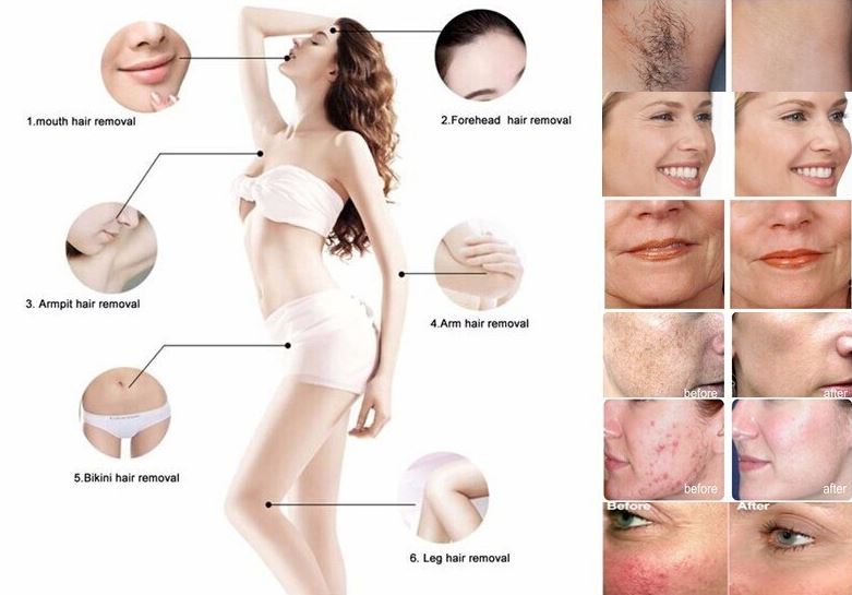 Portable Shr Super Hair Removal Portable Shr Super Hair Removal