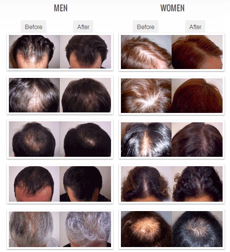 2 Years Warranty Laser Hair Growth Machineser hair growth machine