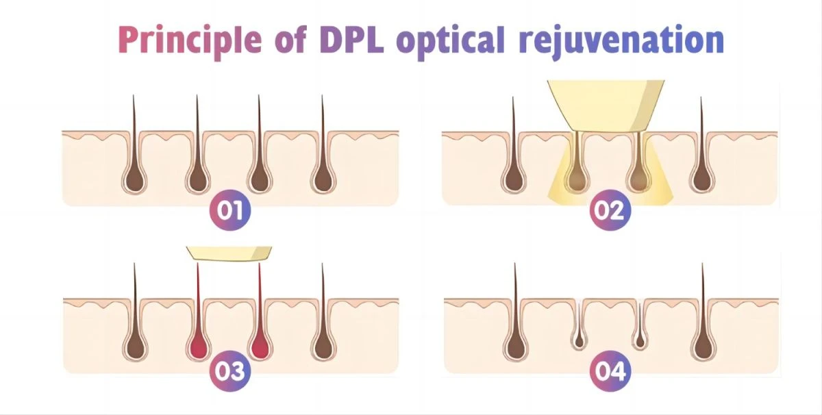 Dpl IPL Laser Hair Removal Equipment Cost High Quality Commercial Use OEM Aesthetics Painless Hair Removal1